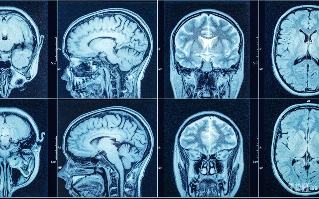 У чому різниця між КТ і МРТ: розповідає нейрохірург